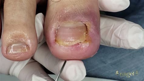 Dedo Infeccionado O Que Fazer