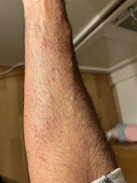 Allergic reaction? : r/DermatologyQuestions