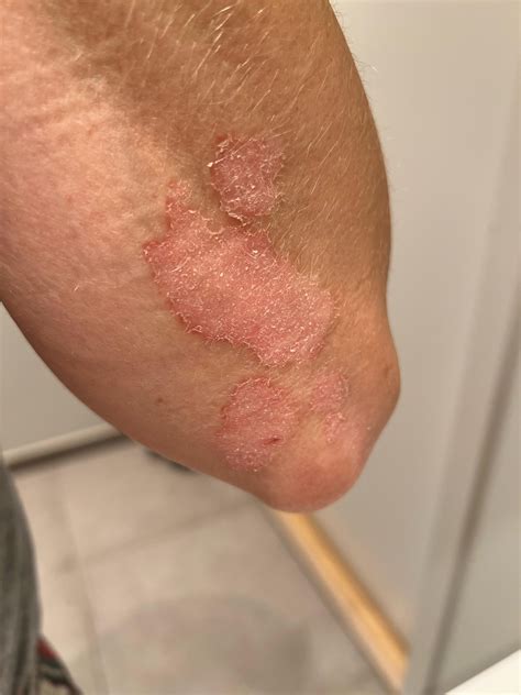 Rash or psoriasis..? : r/lamictal