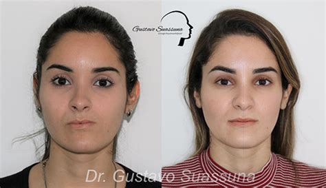 Cirurgia De Atm Antes E Depois