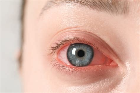 Understanding the Connection Between Allergies and Dry Eye Syndrome