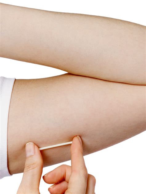 Birth Control Implant