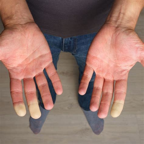 raynauds syndrome overview   treatments