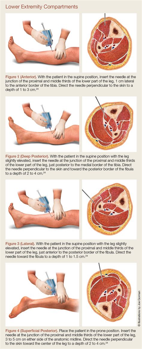 Treatment For Compartment Syndrome – UTVRT