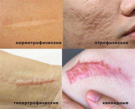 13 мазей от шрамов на лице: самый эффективный крем для заживления и ...