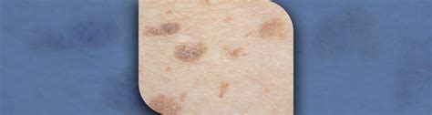 skin cancer iarc