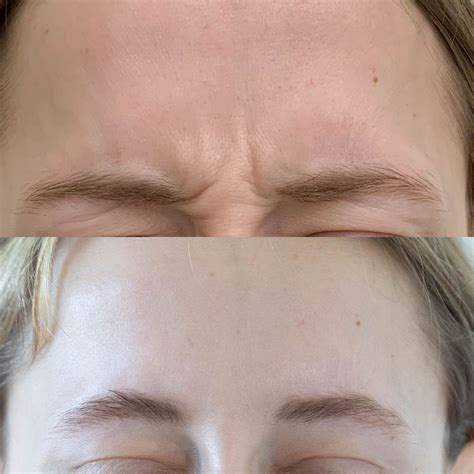Ryppyihin paras! | Botox Helsinki — Ebeling Kauneus