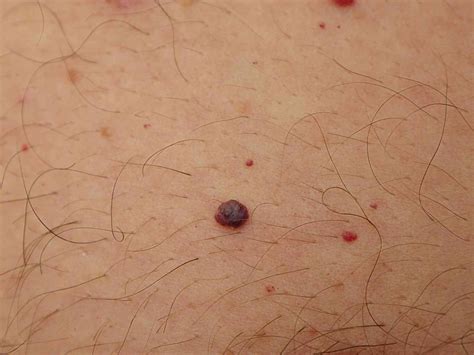 Common lumps and bumps on and under the skin: what are they?