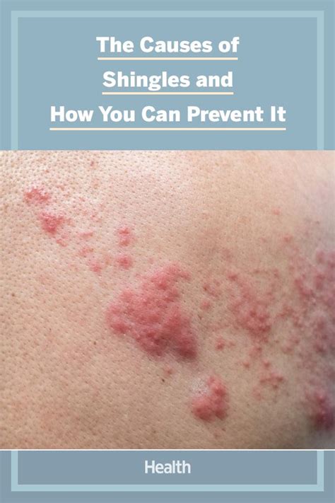 Shingles Stages