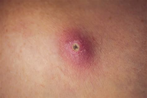 Furuncle: what are the causes of skin inflammation? + What is a ...