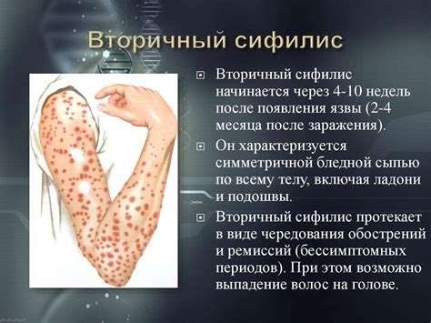 Сифилис. Симптомы сифилиса - презентация онлайн