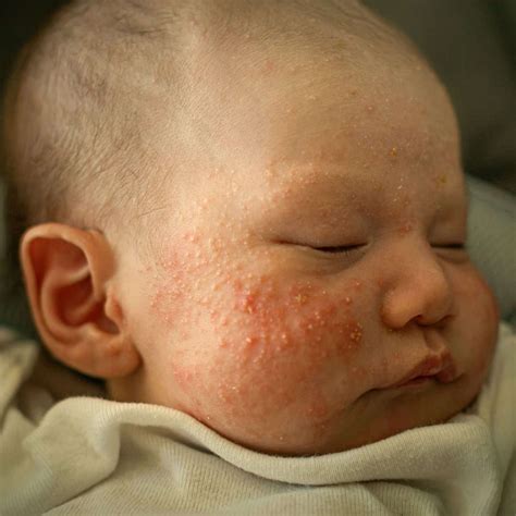 how to get rid of baby acne 2