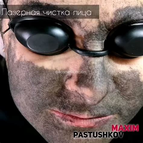 Лазерная чистка лица - YouTube