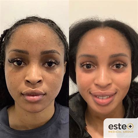Body Hyperpigmentation Before And After at Adelina Simmons blog
