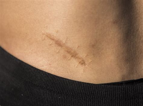 Learn how to reduce the look of scar tissue through massage