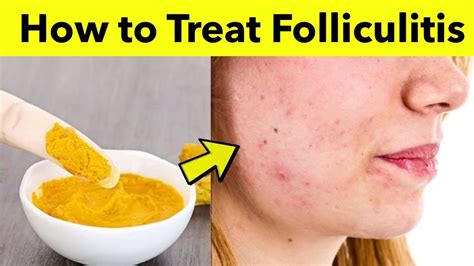 Scalp Folliculitis Cure And Treatment - vrogue.co