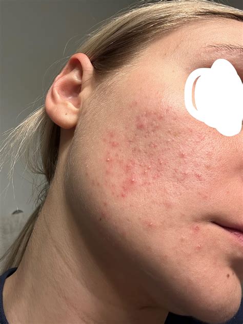 Misdiagnosed? : r/acne