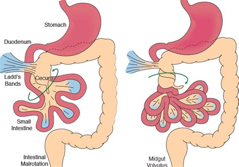 Volvulus & Midgut Malrotations