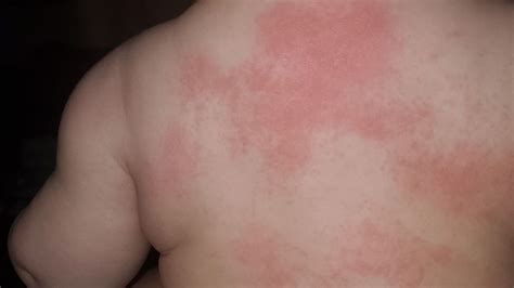 Viral Rash In Children Face - vrogue.co