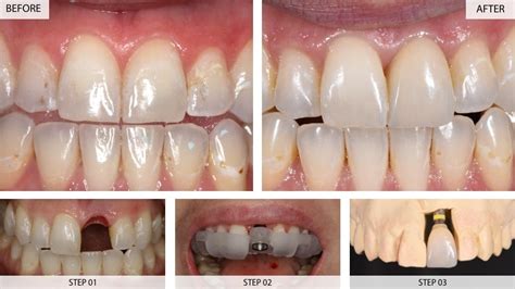 dental implants results    cases