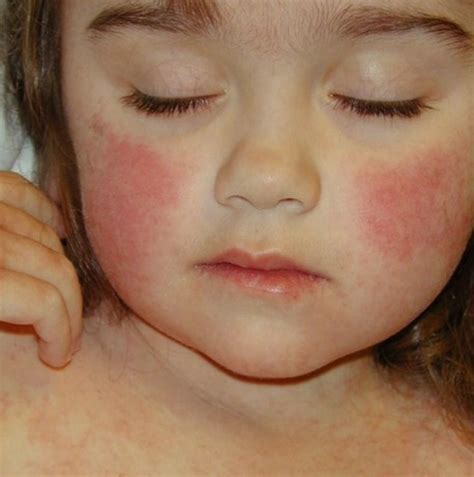Going Viral Rashes Part 2 Pediatrics And Playdough - vrogue.co