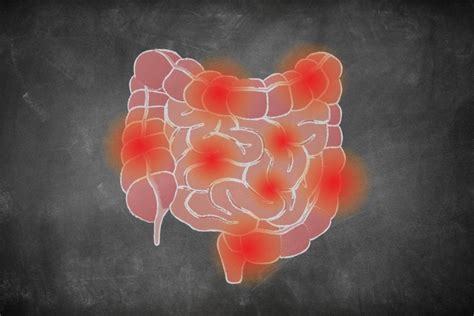 Facts About Crohn’s Disease