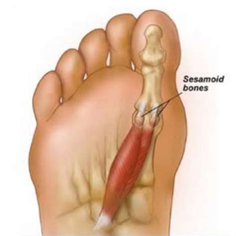 Sesamoiditis and the Sesamoid Bones | HubPages