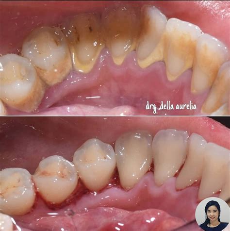 scaling gigi janji dental