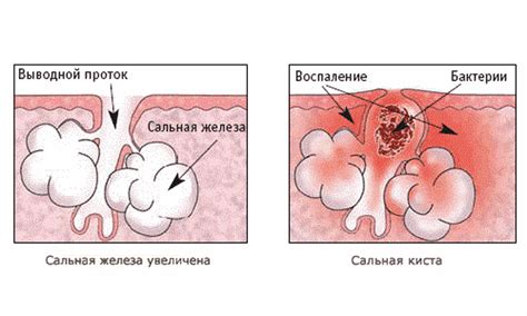 Липома и атерома: Что общего и в чем различия?