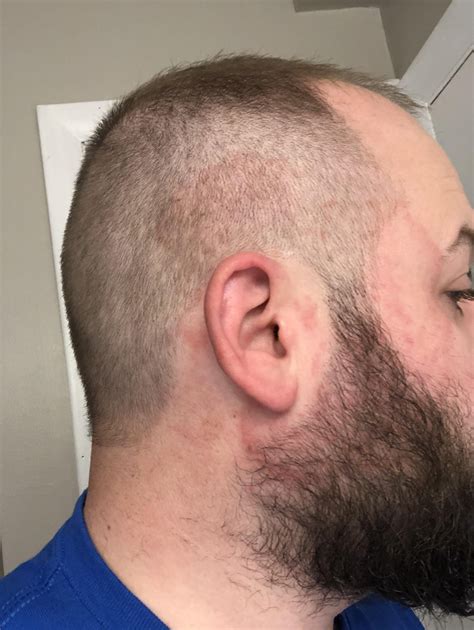 Started around my ear, spreading outward. Now spot in forearm. What is