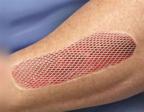 Skin Grafts Explained: Procedure, Aftercare | DFW Wound Care Center
