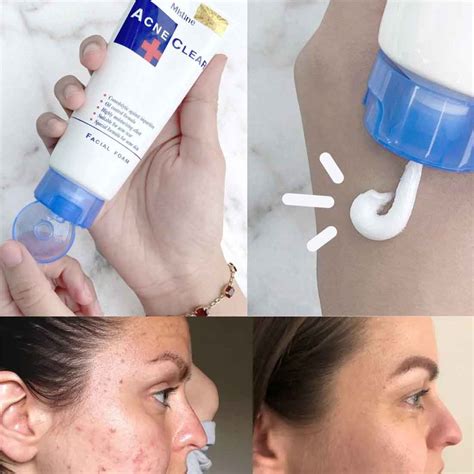 Mistine Acne Clear Facial Foam | Blu Fashion BD