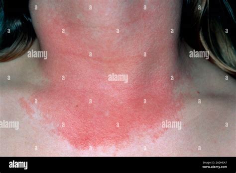 Photosensitivity. A skin rash on the front of a woman's neck caused by ...