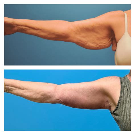 Brachioplasty Patient – 1 | Napa Solano Plastic Surgery & MedSpa