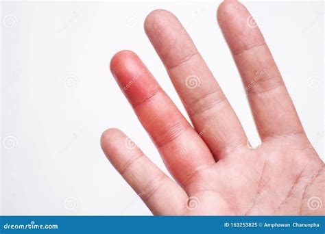 Dedo Vermelho E Inchado