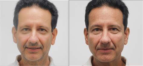 cheek augmentation huntsville cosmetic surgery scottsboro al