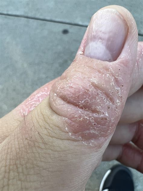 what are these holes in my skin : r/Dyshidrosis