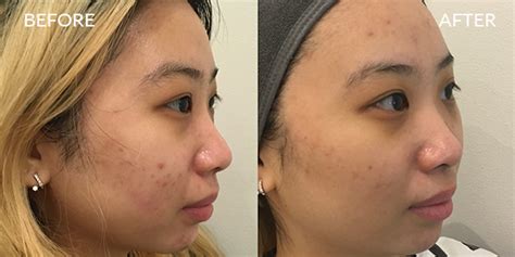 Ipixel Laser Before And After | atelier-yuwa.ciao.jp
