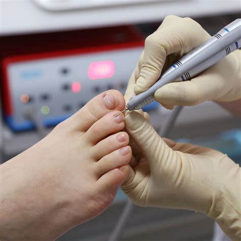 Ingrown Nail Doctor Near Me Flagstaff AZ - Flagstaff Foot Doctors