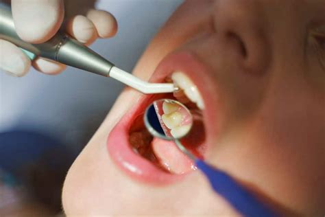 tooth cavity  symptoms treatment  prevention