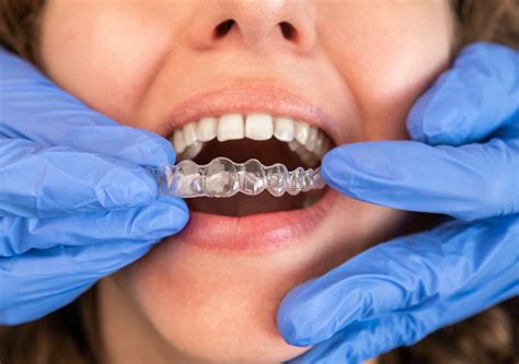 power  invisible aligners  teeth gap correction