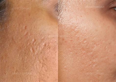 acne scars
