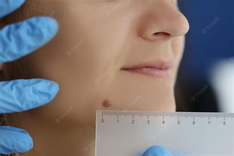 DIY Birthmark Removal: Safe and Effective Options for at-Home Treatment ...