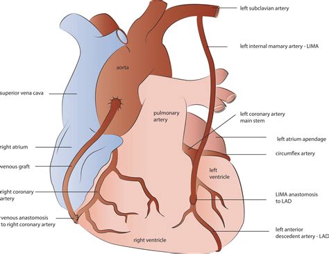 Coronary Artery Bypass Graft Diagram