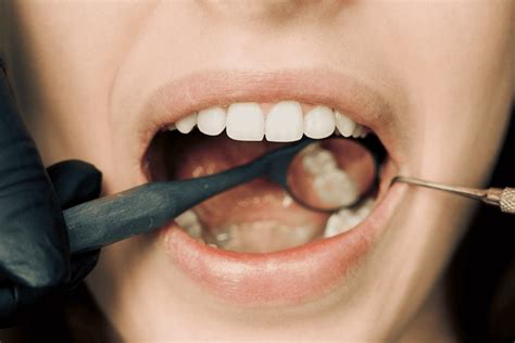 Tooth Abscess: Symptoms, Causes, Types & Treatments - QPIOR