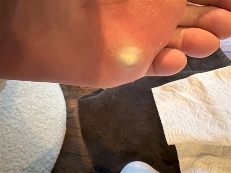 Plantar Wart: a Cantharidin success story (I think) : r/Warts