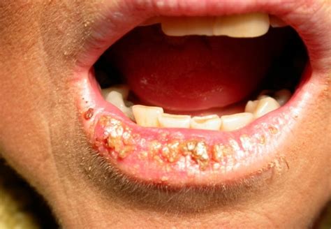 Titanium: A New Allergen | IntechOpen