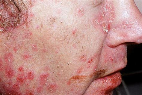 Pustular Psoriasis Symptoms Causes And Treatments Myp - vrogue.co