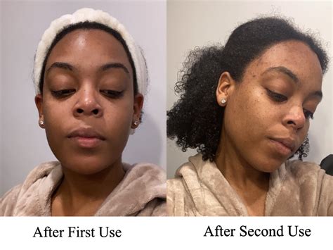 Dull Skin Before After