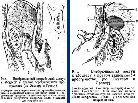 Презентация Поддиафрагмальный абсцесс